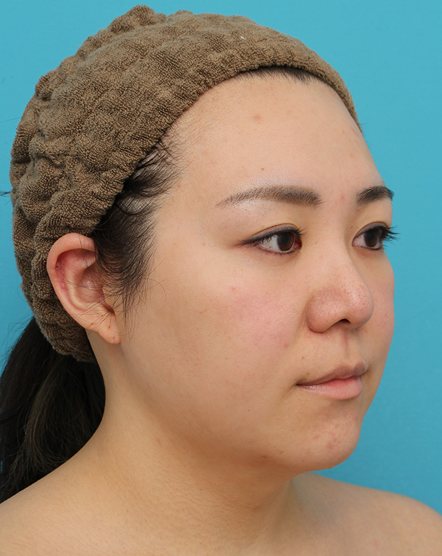 脂肪吸引（頬、あご）,頬～フェイスライン～顎下の脂肪吸引をした20代女性の症例写真,3週間後,mainpic_shibokyuin047i.jpg