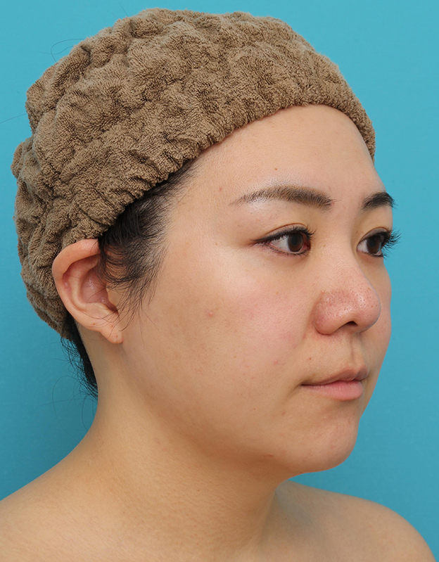症例写真,頬～フェイスライン～顎下の脂肪吸引をした20代女性の症例写真,3ヶ月後,mainpic_shibokyuin047j.jpg