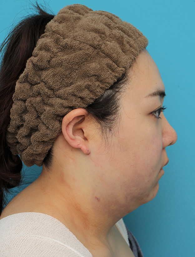 脂肪吸引,頬～フェイスライン～顎下の脂肪吸引をした20代女性の症例写真,手術直後,mainpic_shibokyuin047l.jpg