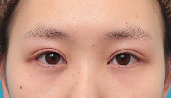垂れ目（パンダ目）形成（グラマラスライン／下眼瞼下制術）,眼瞼下垂手術+目頭切開+目尻切開+グラマラスラインを行った20代女性症例写真,After（2ヶ月後）,ba_ganken044_b01.jpg