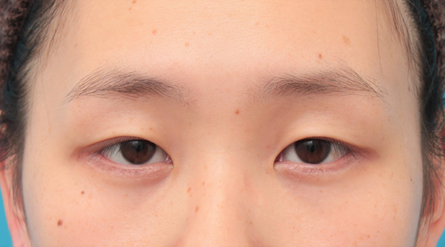 眼瞼下垂（がんけんかすい）,眼瞼下垂手術+目頭切開+目尻切開+グラマラスラインを行った20代女性症例写真,手術前,mainpic_ganken044a.jpg
