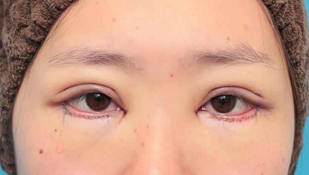 眼瞼下垂（がんけんかすい）,眼瞼下垂手術+目頭切開+目尻切開+グラマラスラインを行った20代女性症例写真,手術直後,mainpic_ganken044b.jpg