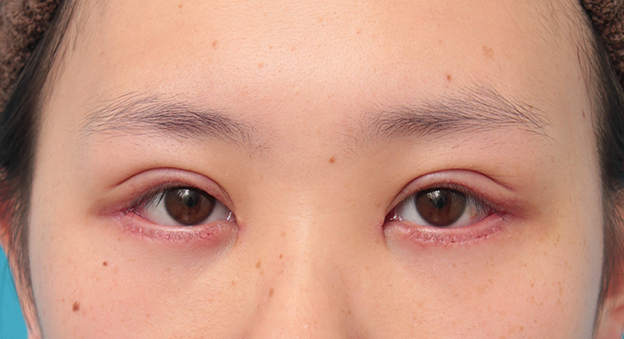 眼瞼下垂（がんけんかすい）,眼瞼下垂手術+目頭切開+目尻切開+グラマラスラインを行った20代女性症例写真,6日後,mainpic_ganken044c.jpg