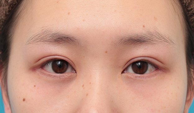 眼瞼下垂（がんけんかすい）,眼瞼下垂手術+目頭切開+目尻切開+グラマラスラインを行った20代女性症例写真,2ヶ月後,mainpic_ganken044d.jpg