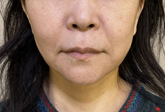脂肪吸引（頬、あご）,ミニフェイスリフト（頬のたるみ取り）,脂肪吸引,ミニフェイスリフト＋フェイスラインの脂肪吸引の症例写真,After（3ヶ月後）,ba_minilift014_a01.jpg
