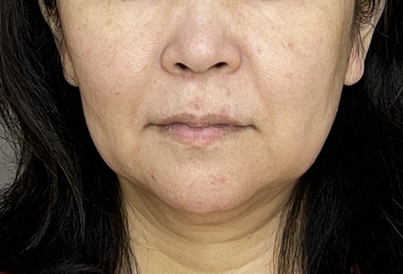 脂肪吸引（頬、あご）,ミニフェイスリフト＋フェイスラインの脂肪吸引の症例写真,Before,ba_minilift014_b01.jpg
