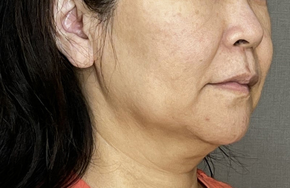 ミニフェイスリフト（頬のたるみ取り）,ミニフェイスリフト＋フェイスラインの脂肪吸引の症例写真,Before,ba_minilift014_b02.jpg