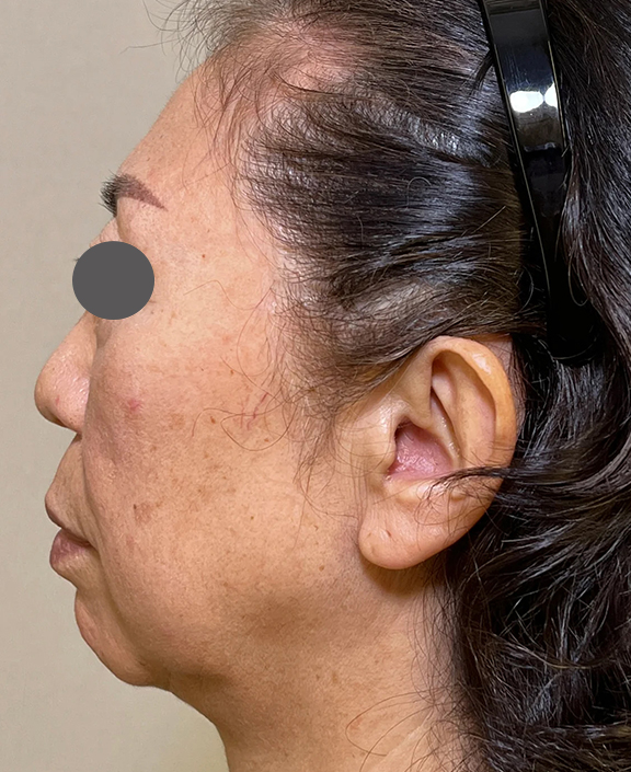 あご注射（ヒアルロン酸）,ミディアムフェイスリフト＋顎下脂肪吸引＋あごにヒアルロン酸注射をした症例写真,Before,ba_facelift007_b02.jpg