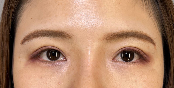 二重まぶた・全切開法,二重まぶた切開法で眼瞼下垂手術と同じくらい目をパッチリさせた症例写真,After（目を開けた状態）
（3ヶ月後）,ba_sekkai091_a01.jpg