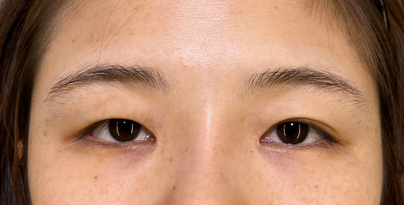 二重まぶた切開法で眼瞼下垂手術と同じくらい目をパッチリさせた症例写真,Before,ba_sekkai091_b01.jpg