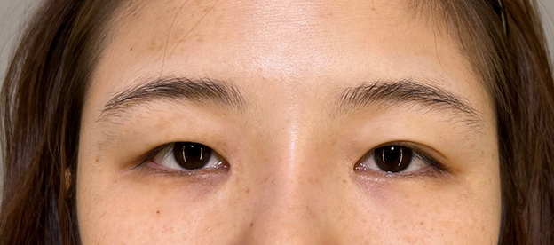 症例写真,二重まぶた切開法で眼瞼下垂手術と同じくらい目をパッチリさせた症例写真,手術前,mainpic_sekkai091a.jpg