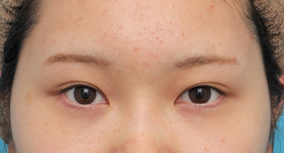 グラマラスライン（垂れ目形成手術）を行った20代女性の症例写真,After（6ヶ月後）,ba_panda023_a01.jpg