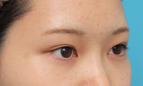 症例写真,グラマラスライン（垂れ目形成手術）を行った20代女性の症例写真,After（6ヶ月後）,ba_panda023_b02.jpg