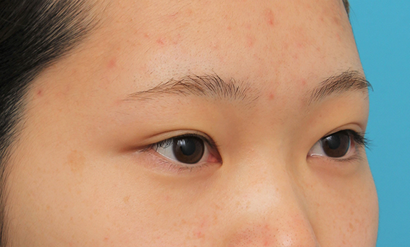 症例写真,グラマラスライン（垂れ目形成手術）を行った20代女性の症例写真,Before,ba_panda023_b02.jpg