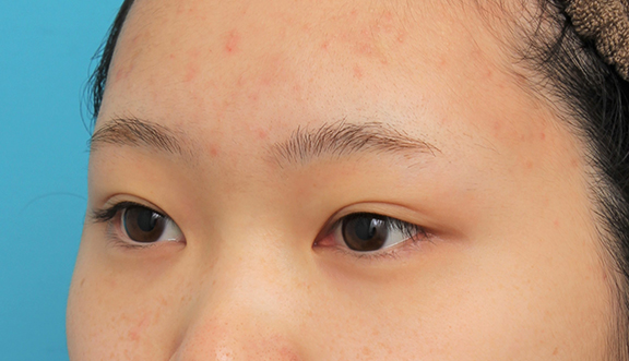 症例写真,グラマラスライン（垂れ目形成手術）を行った20代女性の症例写真,Before,ba_panda023_b03.jpg