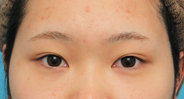 症例写真,グラマラスライン（垂れ目形成手術）を行った20代女性の症例写真,手術前,mainpic_panda023a.jpg