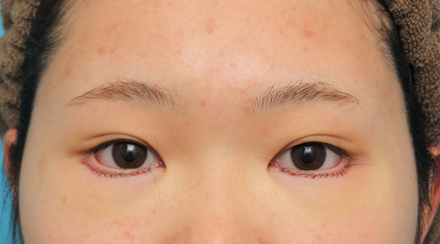 垂れ目（パンダ目）形成（グラマラスライン／下眼瞼下制術）,グラマラスライン（垂れ目形成手術）を行った20代女性の症例写真,手術直後,mainpic_panda023b.jpg