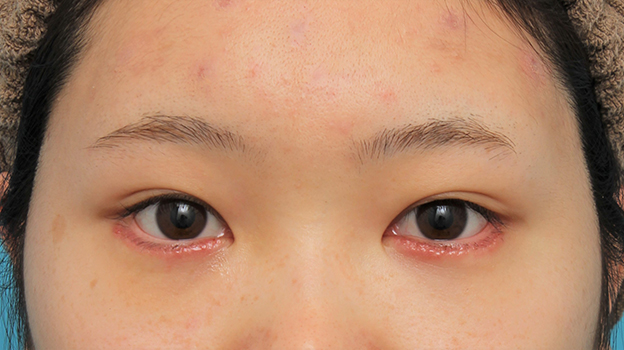 垂れ目（パンダ目）形成（グラマラスライン／下眼瞼下制術）,グラマラスライン（垂れ目形成手術）を行った20代女性の症例写真,6日後,mainpic_panda023c.jpg