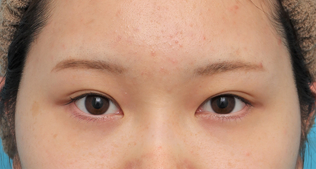 垂れ目（パンダ目）形成（グラマラスライン／下眼瞼下制術）,グラマラスライン（垂れ目形成手術）を行った20代女性の症例写真,6ヶ月後,mainpic_panda023e.jpg