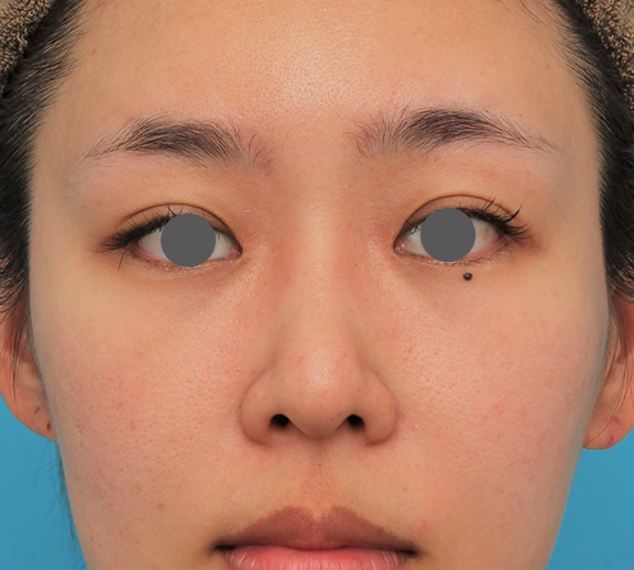 わし鼻・段鼻修正,ハンプ切除,ハンプ切除+鼻骨切り幅寄せ+鼻尖縮小を行った20代女性の症例写真,After（4ヶ月後）,ba_hump015_b01.jpg