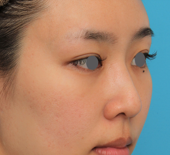 骨切幅寄せ（鼻の根元を細く）,ハンプ切除+鼻骨切り幅寄せ+鼻尖縮小を行った20代女性の症例写真,After（4ヶ月後）,ba_hump015_b02.jpg