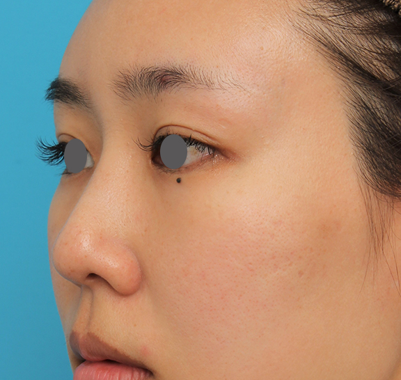 わし鼻・段鼻修正,ハンプ切除,ハンプ切除+鼻骨切り幅寄せ+鼻尖縮小を行った20代女性の症例写真,After（4ヶ月後）,ba_hump015_b03.jpg