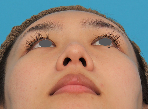 わし鼻・段鼻修正,ハンプ切除,ハンプ切除+鼻骨切り幅寄せ+鼻尖縮小を行った20代女性の症例写真,After（4ヶ月後）,ba_hump015_b04.jpg