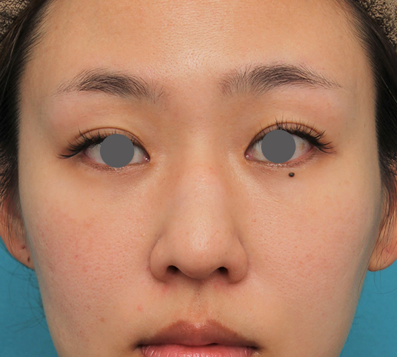 わし鼻・段鼻修正,ハンプ切除,ハンプ切除+鼻骨切り幅寄せ+鼻尖縮小を行った20代女性の症例写真,Before,ba_hump015_b01.jpg