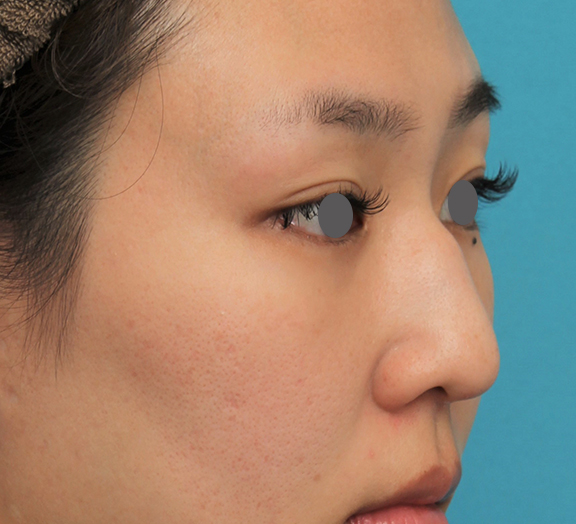 骨切幅寄せ（鼻の根元を細く）,ハンプ切除+鼻骨切り幅寄せ+鼻尖縮小を行った20代女性の症例写真,Before,ba_hump015_b02.jpg