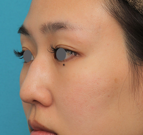 わし鼻・段鼻修正,ハンプ切除,ハンプ切除+鼻骨切り幅寄せ+鼻尖縮小を行った20代女性の症例写真,Before,ba_hump015_b03.jpg
