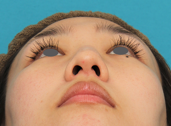 わし鼻・段鼻修正,ハンプ切除,ハンプ切除+鼻骨切り幅寄せ+鼻尖縮小を行った20代女性の症例写真,Before,ba_hump015_b04.jpg