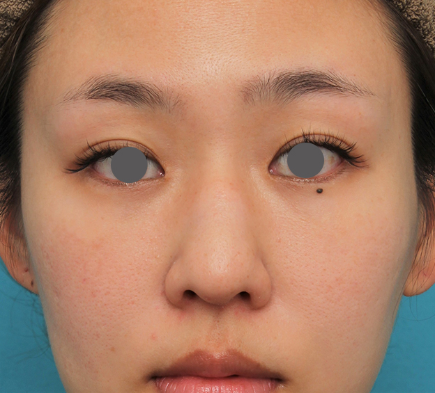 わし鼻・段鼻修正,ハンプ切除,ハンプ切除+鼻骨切り幅寄せ+鼻尖縮小を行った20代女性の症例写真,手術前,mainpic_hump015a.jpg