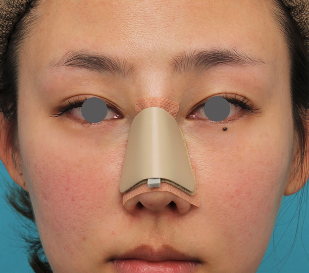 骨切幅寄せ（鼻の根元を細く）,ハンプ切除+鼻骨切り幅寄せ+鼻尖縮小を行った20代女性の症例写真,手術直後,mainpic_hump015b.jpg