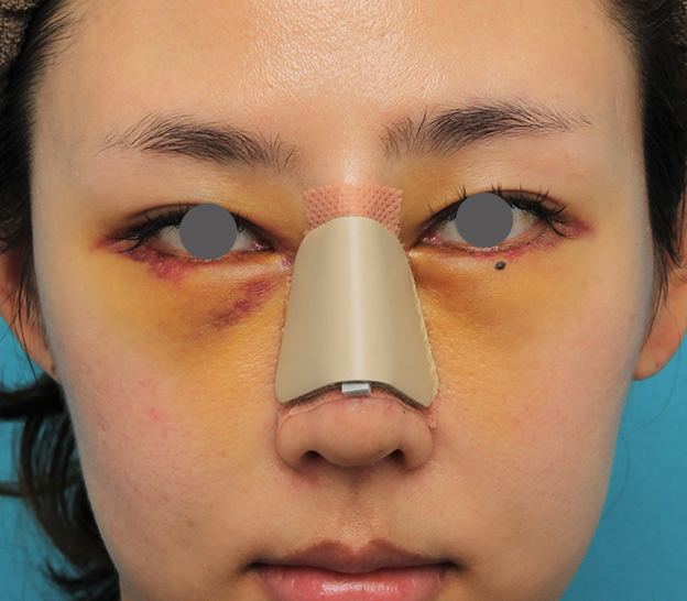 骨切幅寄せ（鼻の根元を細く）,ハンプ切除+鼻骨切り幅寄せ+鼻尖縮小を行った20代女性の症例写真,3日後,mainpic_hump015c.jpg