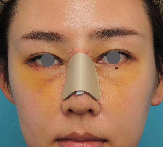わし鼻・段鼻修正,ハンプ切除,ハンプ切除+鼻骨切り幅寄せ+鼻尖縮小を行った20代女性の症例写真,1週間後,mainpic_hump015d.jpg