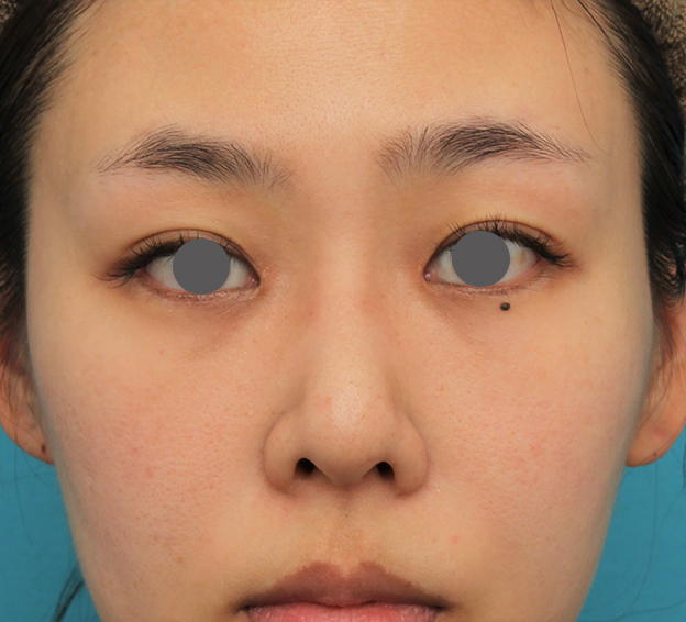 わし鼻・段鼻修正,ハンプ切除,ハンプ切除+鼻骨切り幅寄せ+鼻尖縮小を行った20代女性の症例写真,1ヶ月後,mainpic_hump015f.jpg