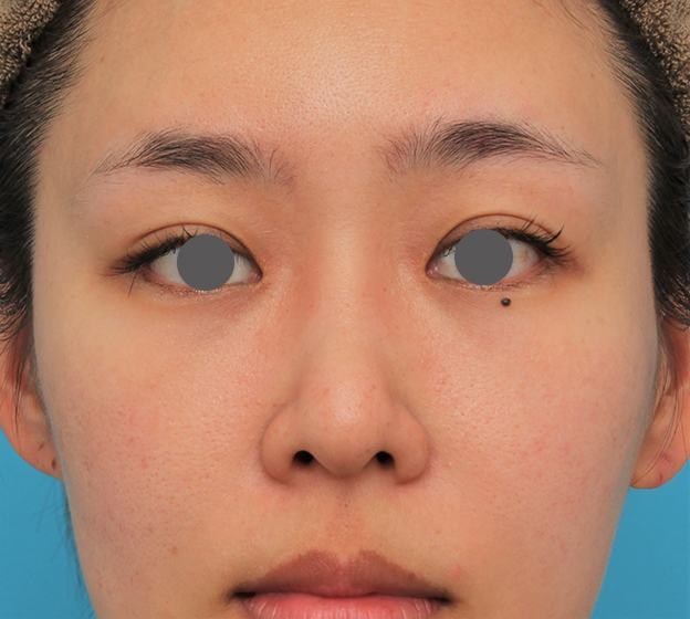わし鼻・段鼻修正,ハンプ切除,ハンプ切除+鼻骨切り幅寄せ+鼻尖縮小を行った20代女性の症例写真,4ヶ月後,mainpic_hump015g.jpg