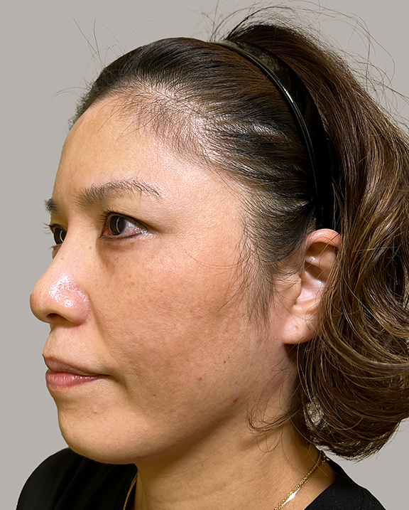 イタリアンリフト,イタリアンリフト+イタリアンリフトファイン+顎ボトックス注射を行った40代女性の症例写真,Before,ba_italian034_b02.jpg