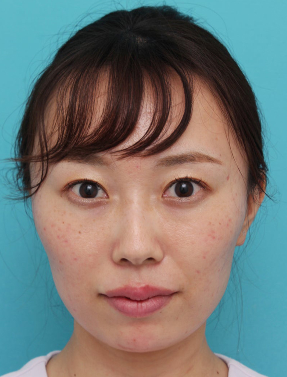 ヒアルロン酸で唇を厚く（ふっくら・アヒル口etc）,顎と唇にヒアルロン酸を注入した20代女性の症例写真,After（手術後）,ba_agochu019_b01.jpg