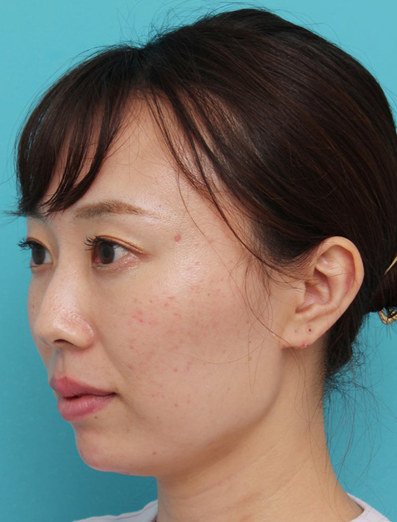 あご注射（ヒアルロン酸）,顎と唇にヒアルロン酸を注入した20代女性の症例写真,After（手術後）,ba_agochu019_b02.jpg