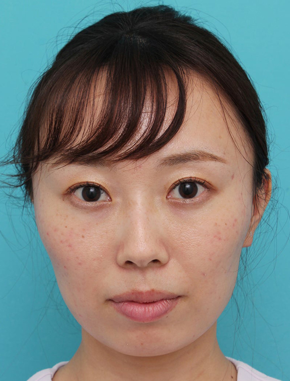 ヒアルロン酸で唇を厚く（ふっくら・アヒル口etc）,顎と唇にヒアルロン酸を注入した20代女性の症例写真,Before,ba_agochu019_b01.jpg