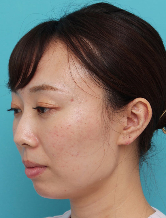 ヒアルロン酸で唇を厚く（ふっくら・アヒル口etc）,顎と唇にヒアルロン酸を注入した20代女性の症例写真,Before,ba_agochu019_b02.jpg