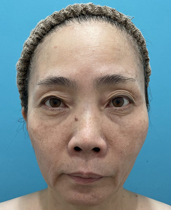 目の下の脂肪取り,三方向から眼窩内脂肪を除去した目の下の切らない脂肪取りの症例写真,After（1ヶ月後）,ba_shibo001_a01.jpg