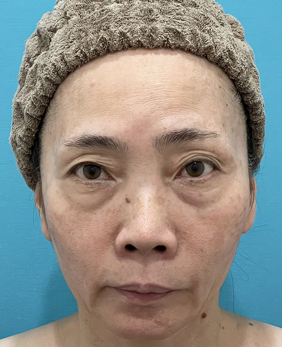 目の下の脂肪取り,三方向から眼窩内脂肪を除去した目の下の切らない脂肪取りの症例写真,Before,ba_shibo001_b01.jpg