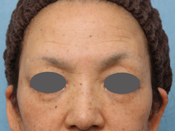フォトフェイシャルM22,こめかみへのヒアルロン酸注入＋肌へのフォトフェイシャルM22を行った症例写真,After（1ヶ月後）,ba_komekami_001_b01.jpg
