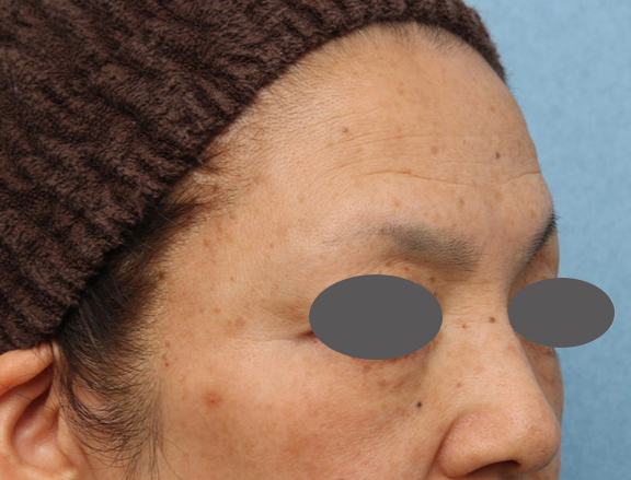 症例写真,こめかみへのヒアルロン酸注入＋肌へのフォトフェイシャルM22を行った症例写真,After（1ヶ月後）,ba_komekami_001_b03.jpg