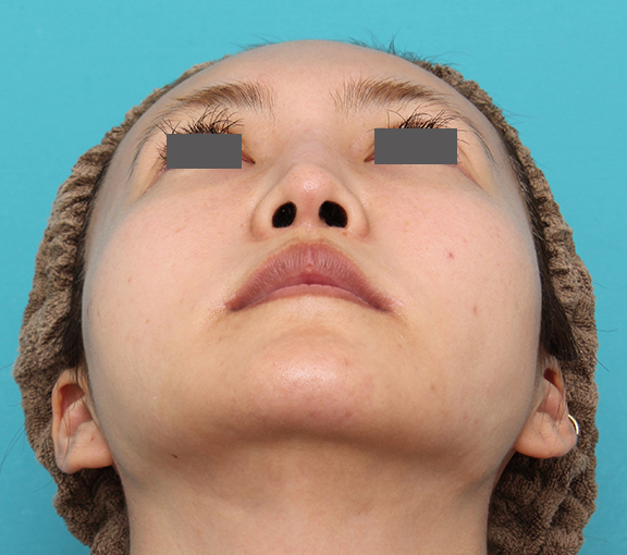 鼻の下を短く（上口唇短縮手術、上口唇リフト、リップリフト、人中短縮術）,人中短縮+口角挙上+小鼻縮小を行った30代女性症例写真,After（6ヶ月後）,ba_hanashita009_b02.jpg