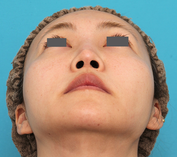 鼻翼縮小（小鼻縮小）,人中短縮+口角挙上+小鼻縮小を行った30代女性症例写真,Before,ba_hanashita009_b02.jpg