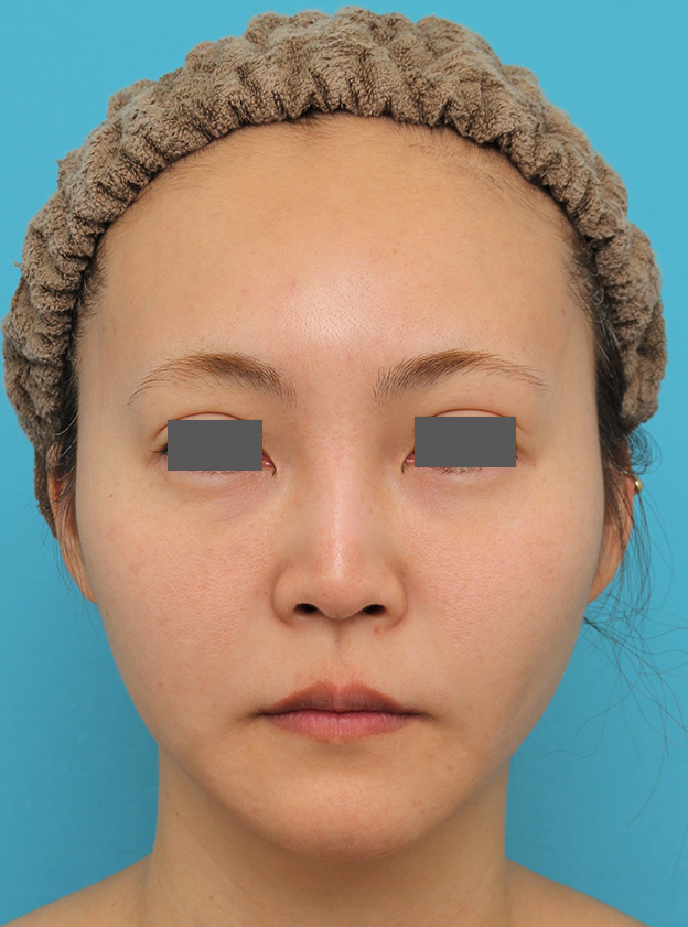 口角拳上術,人中短縮+口角挙上+小鼻縮小を行った30代女性症例写真,手術前,mainpic_hanashita009a.jpg