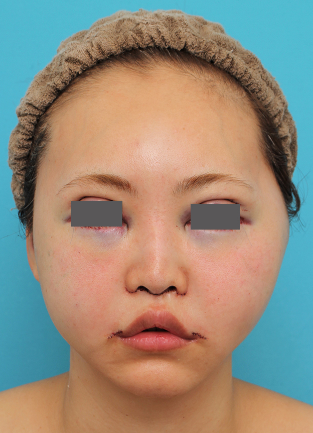 鼻の下を短く（上口唇短縮手術、上口唇リフト、リップリフト、人中短縮術）,人中短縮+口角挙上+小鼻縮小を行った30代女性症例写真,手術直後,mainpic_hanashita009b.jpg